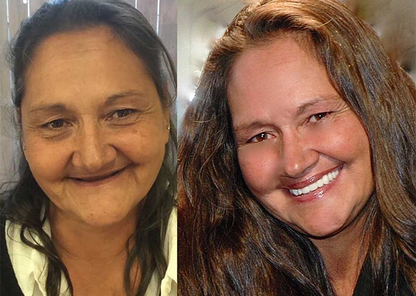 Allday Secure Tandproteslim