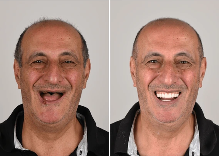 Allday Secure Tandproteslim