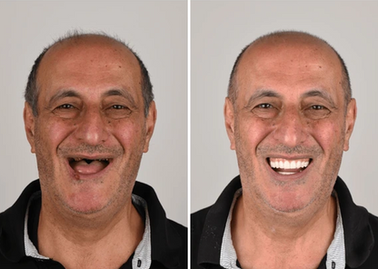 Allday Secure Tandproteslim